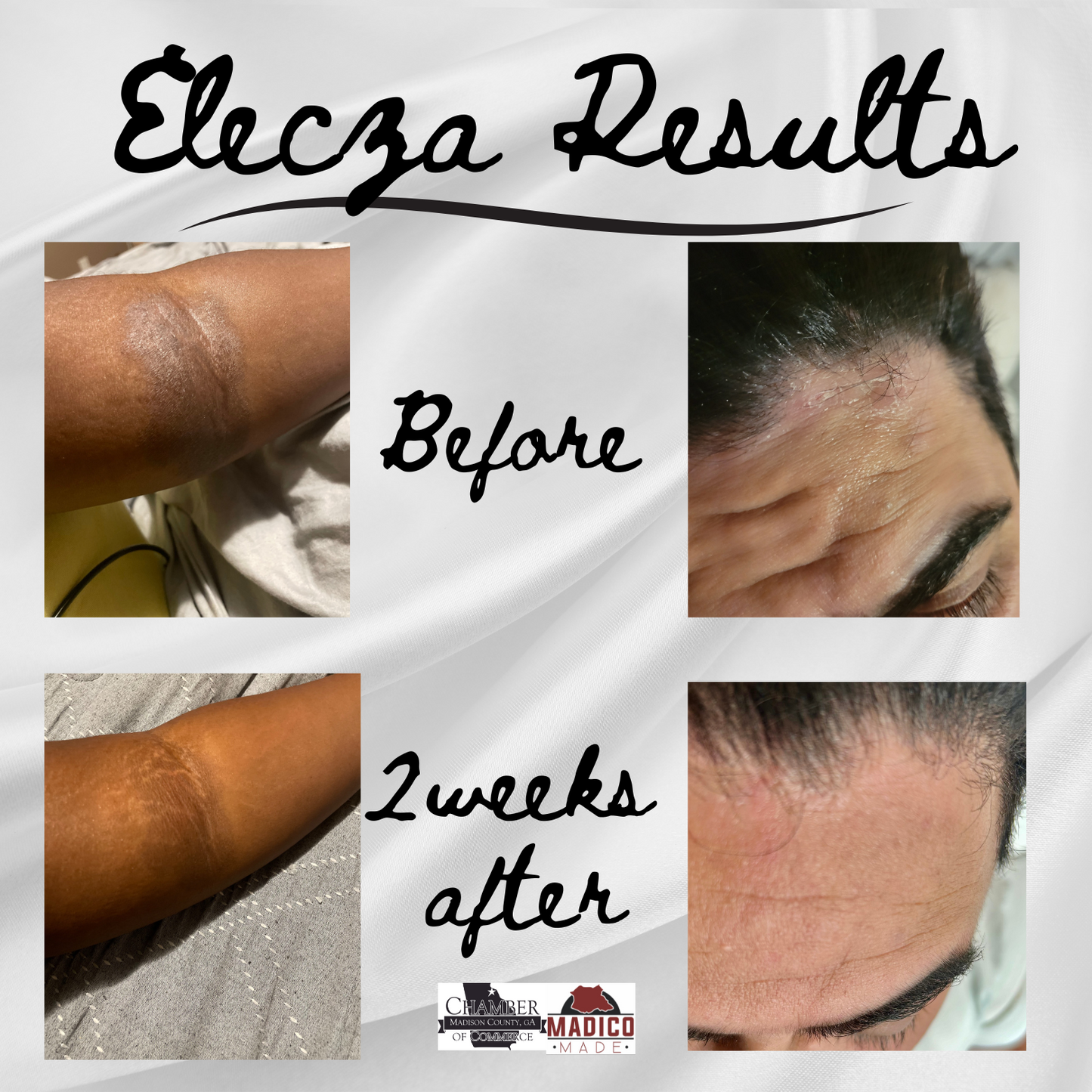 Elecza Eczema Relief Tallow Balm for Sensitive Skin, Dryness & Irritation (Barrier Repair Moisturizer)