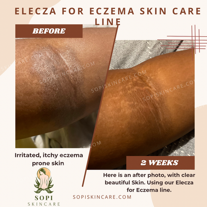 Eczema Relief Set