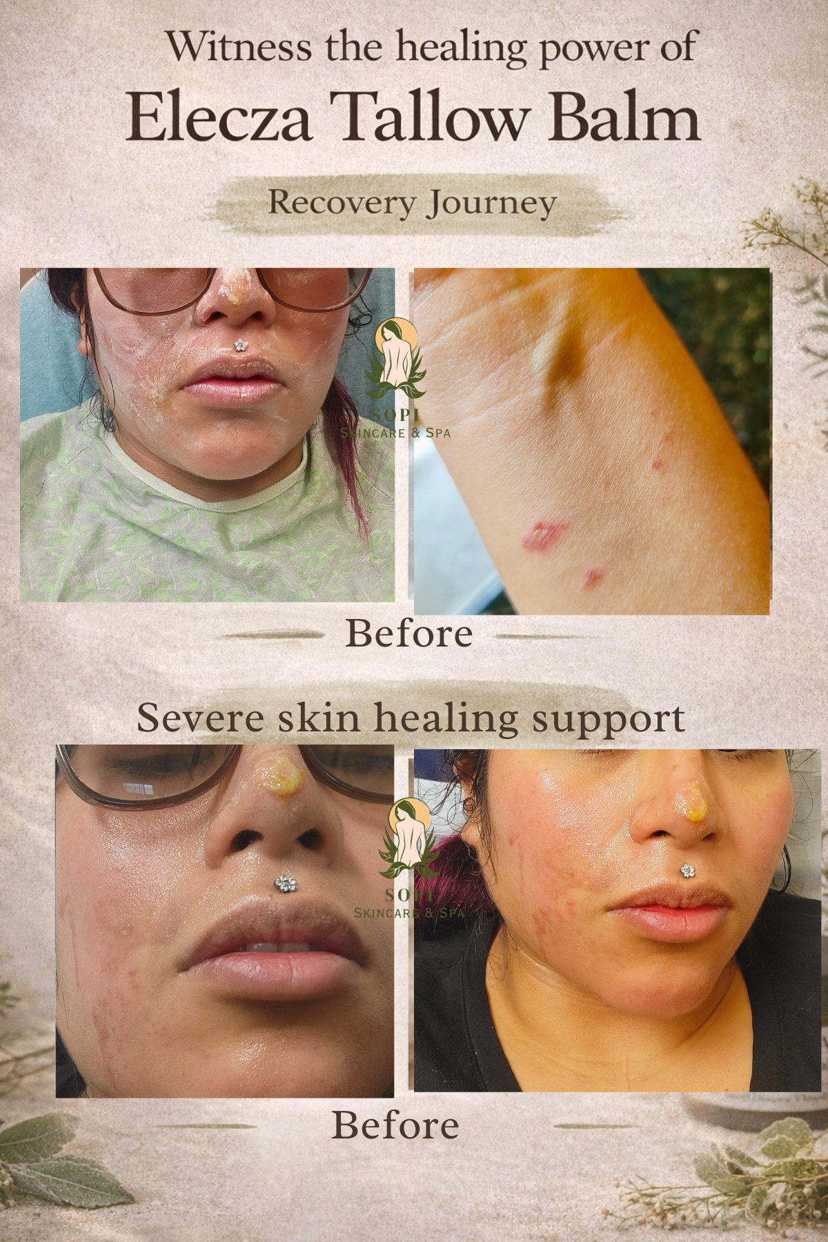 Elecza Eczema Relief Tallow Balm for Sensitive Skin, Dryness & Irritation (Barrier Repair Moisturizer)